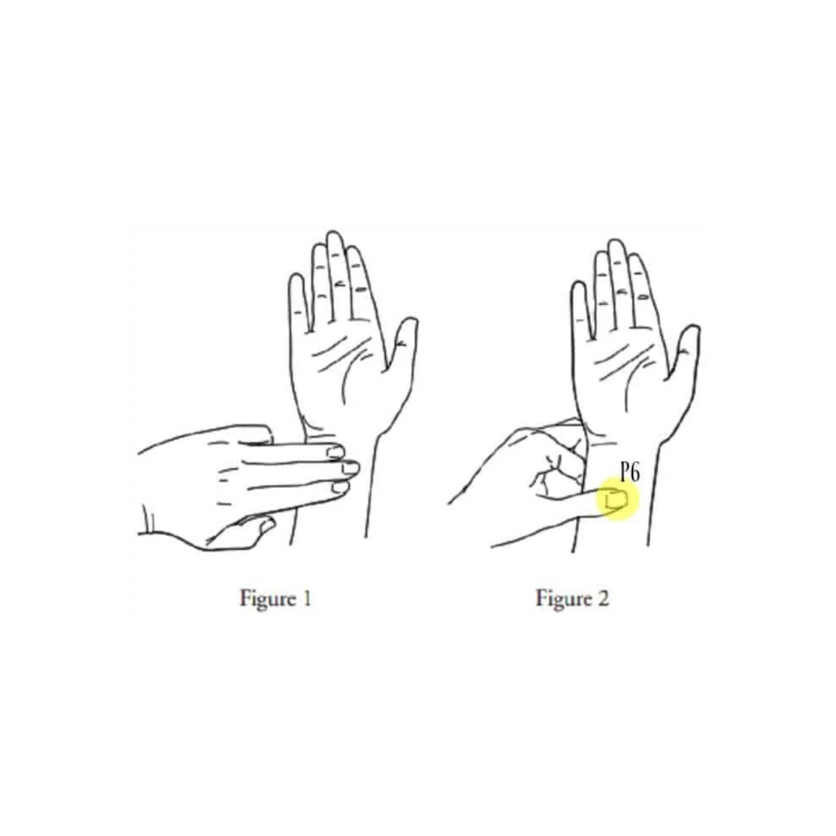 Nėštumo Pykinimo Malšinimo Juostos (Akupresūros Apyrankės)