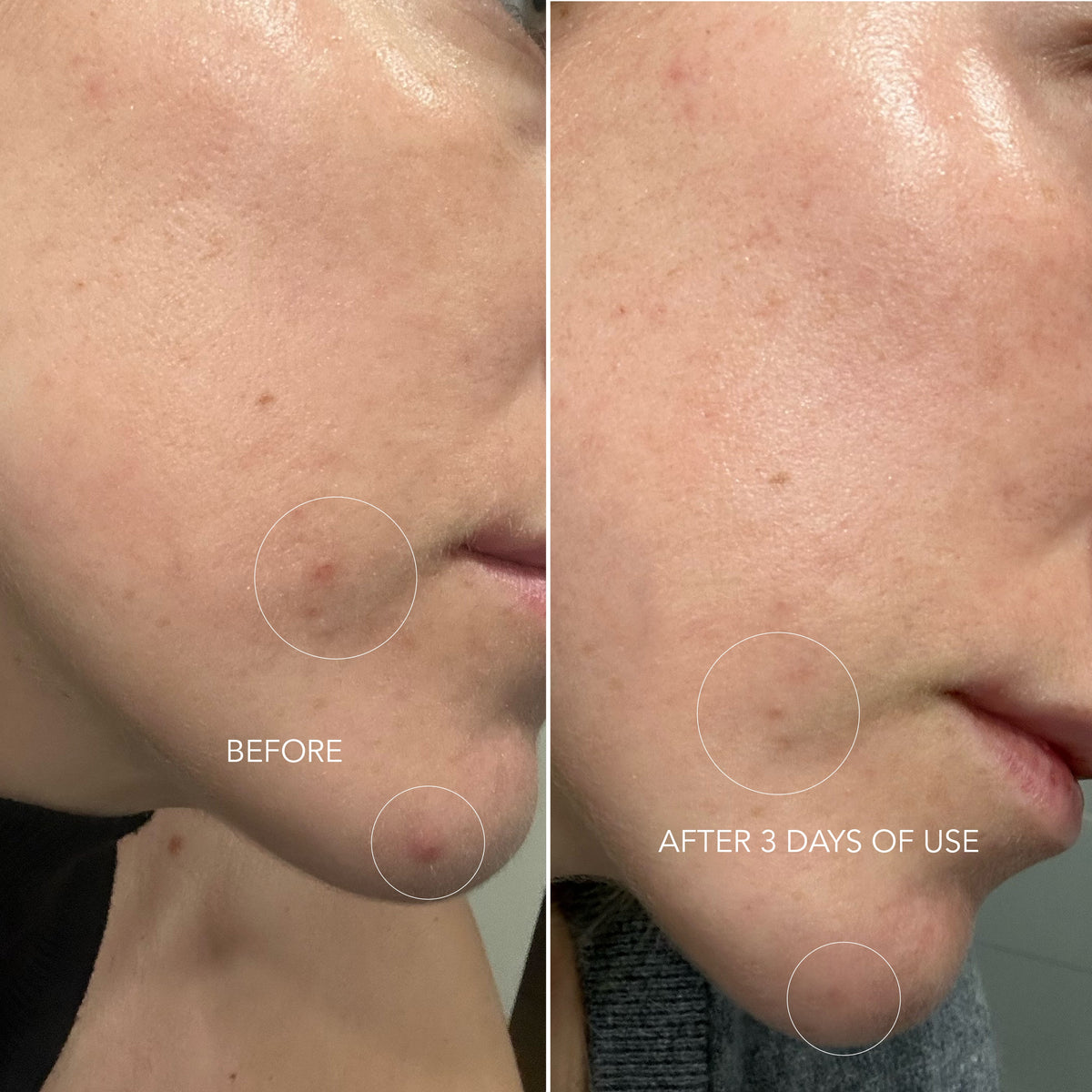 SOS Drying Lotion acne treatment 30ml